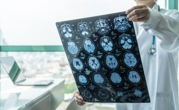 Questo farmaco per l’Alzheimer riduce i sintomi del 30 percento, afferma un nuovo studio